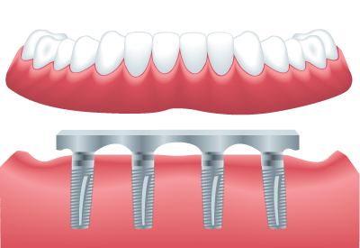 Implant Supported Dentures in Winter Park, FL