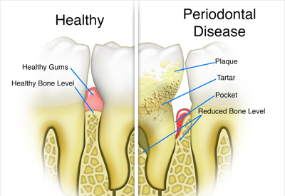 Gum Disease and Tooth and Bone Loss Winter Park, FL